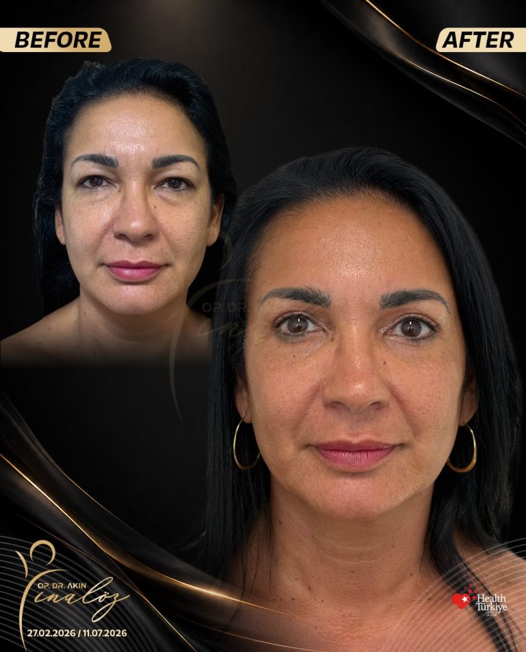 FACE1