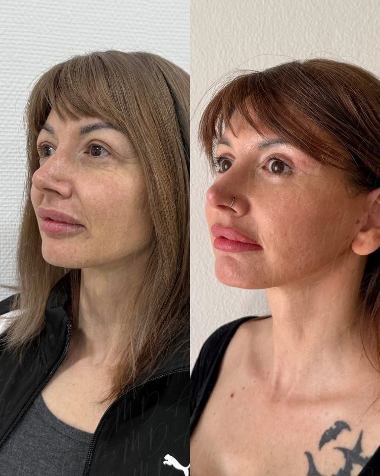 FACE4
