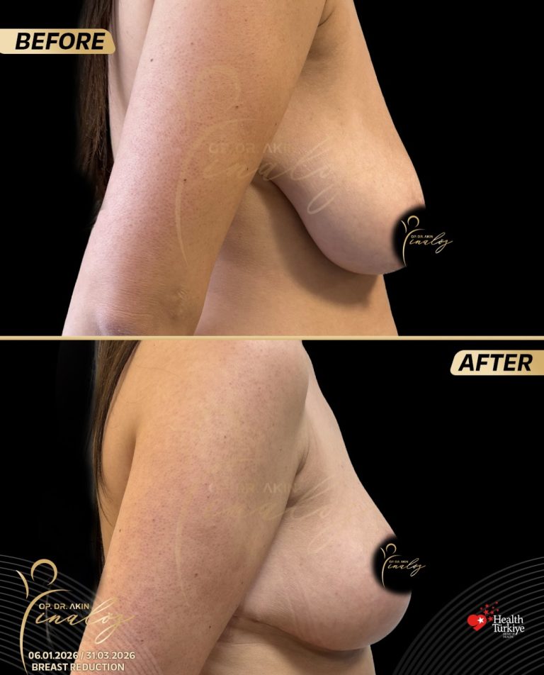 breast2-2